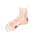 Diabetischer-Fuß-Footlogics-Einlegesohlen