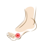 Großzehenballen-Hallux-Valgus-Footlogics-Einlegesohlen-150x150